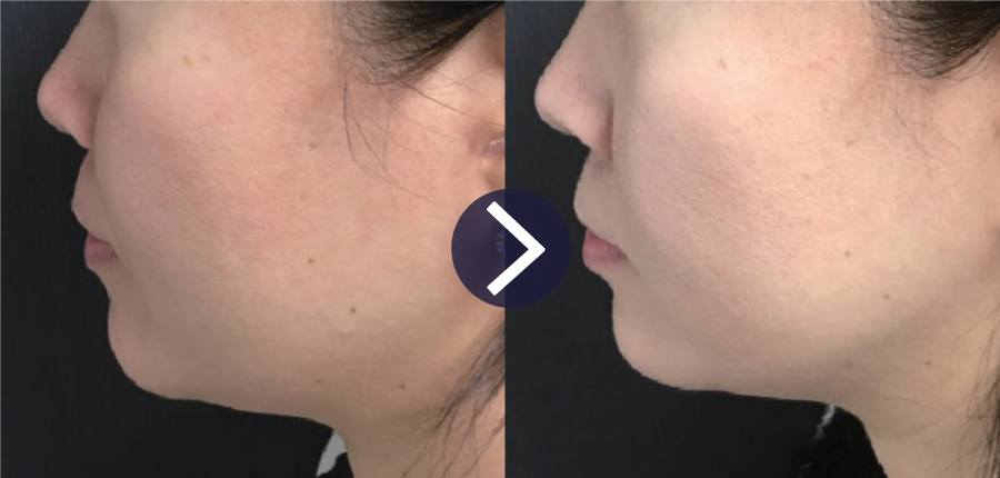 Before and After HIFU 10 Thera